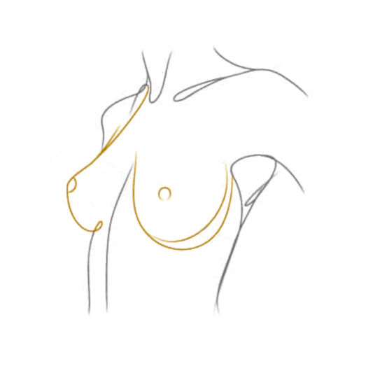 Breast surgery