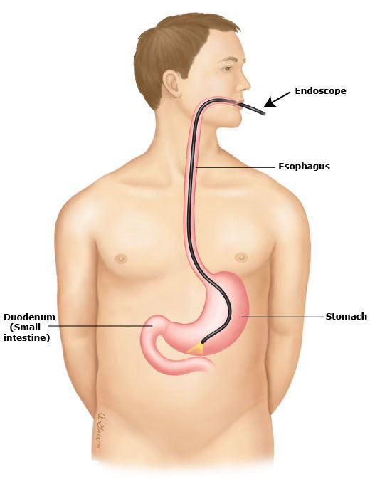 Gastroscopy